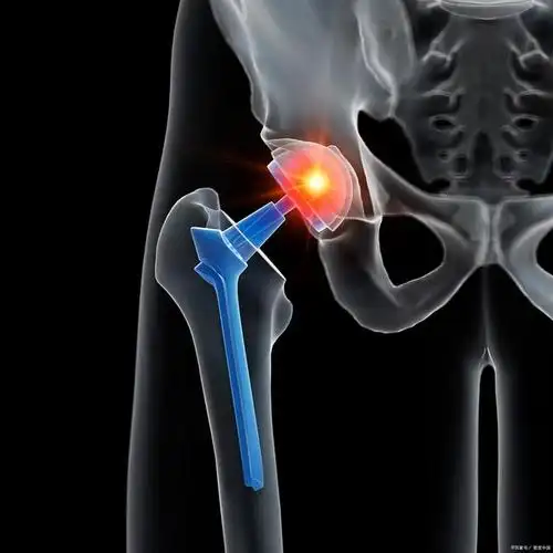 髋关节骨性关节炎,常见的症状有哪些?