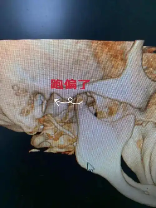 健康迎亚运丨打个哈欠下巴掉了医生2秒助其复位