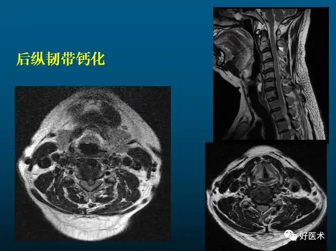 颈椎病的mri诊断技巧
