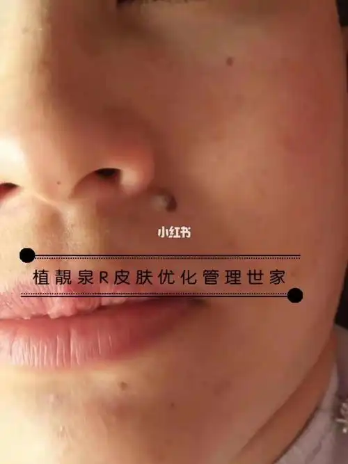 去个肉痣哪有那么麻烦,不留疤不留坑不留印