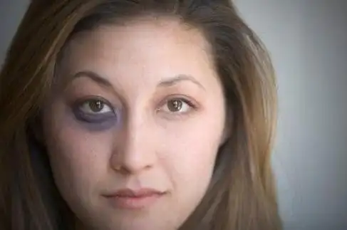 [健康常识]黑眼圈不仅是因为肾虚 黑眼圈透露你身体的健康问题