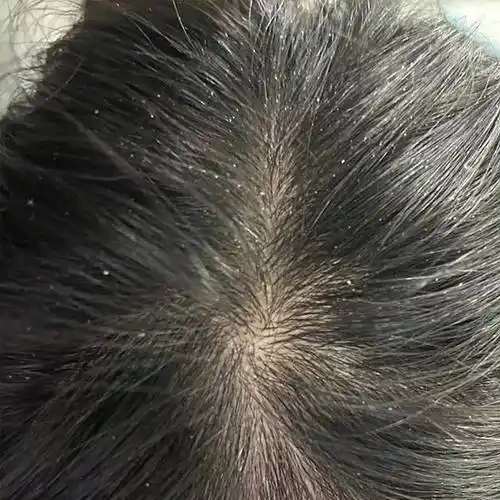 p>头皮屑,头油,头痒困扰不断?