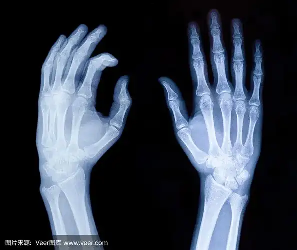 x射线的手