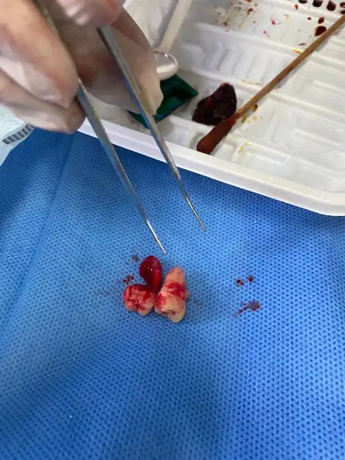 拔了智齿,好残忍,好血腥