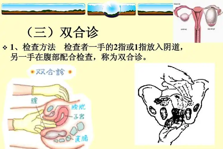 (三)双合诊   1,检查方法 检查者一手的2指或1指放入阴道, 另一手在