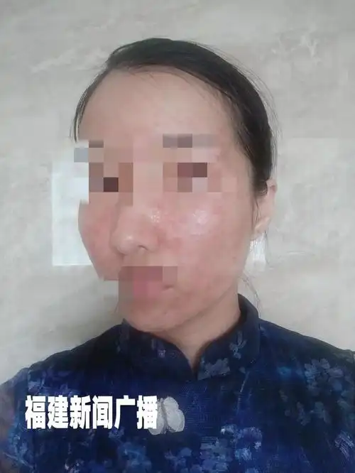美容变毁容福州一女子痛哭福州东南眼科医院不靠谱