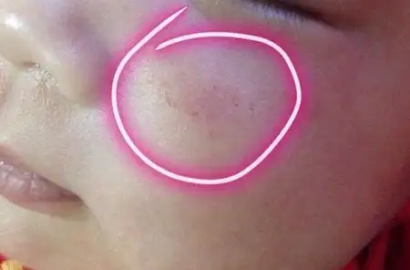 问:宝宝脸上有红色的小点,像是出血点一样,大哭后更加明显,有时聚集在