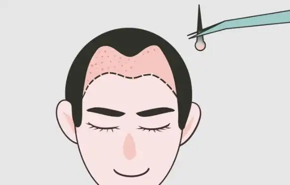 2,发际线过高的原因有哪些