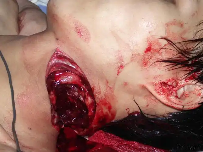 颈部刀砍伤一例