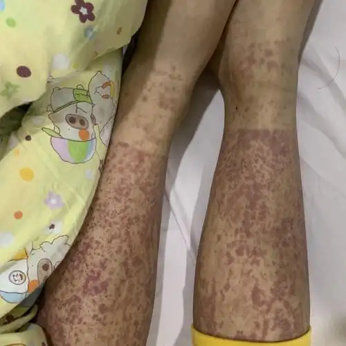 认识儿童过敏性紫癜_医学界-助力医生临床决策和职业成长