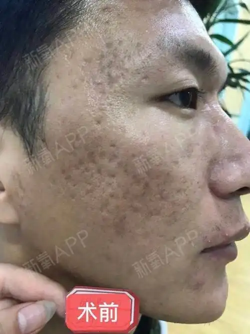 说真的,对自己这张痘印痘坑脸简直看不下去,不知道别人看到是什么感觉