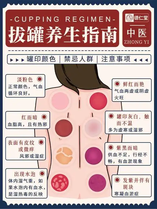 拔罐养生指南:罐印颜色/禁忌人群/注意事项