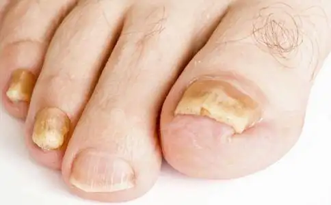治疗灰指甲偏方有哪些