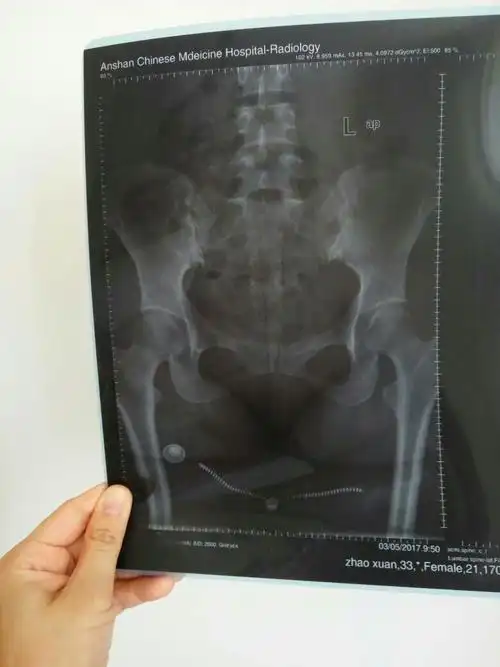 从床上摔下来,尾骨骨裂