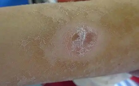 男生阴囊痒湿疹图片