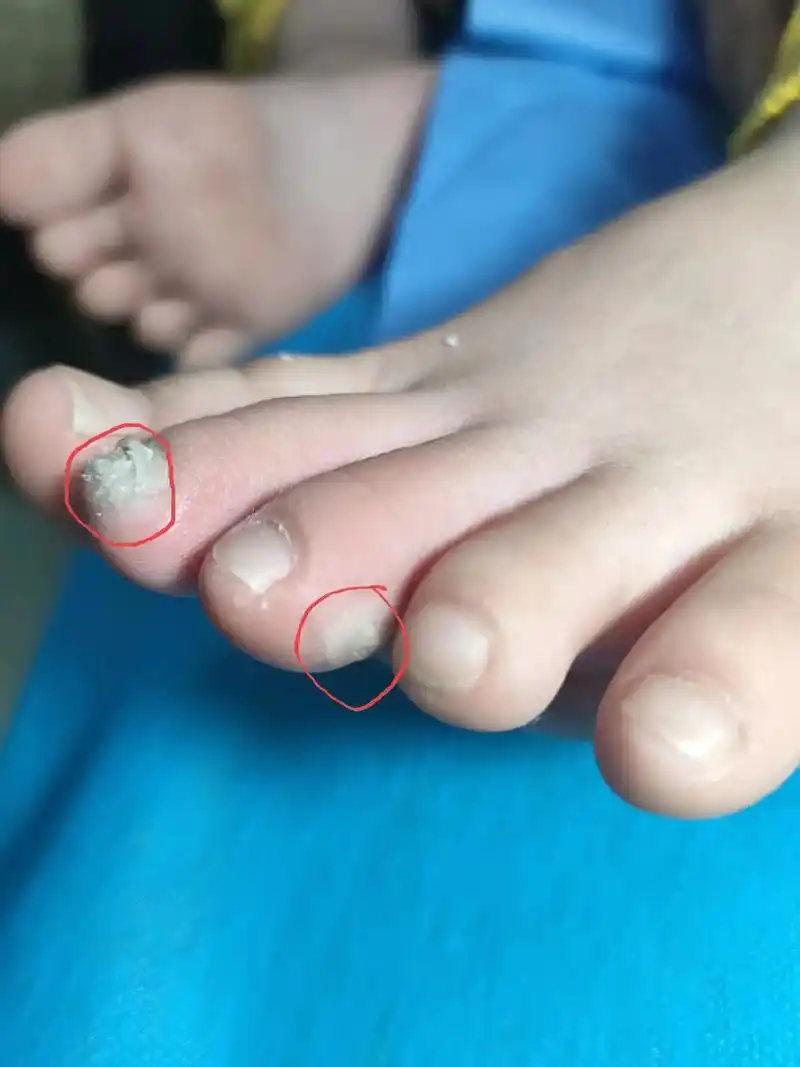 不要小看跖疣!7岁小朋友,脚上长了一个"小疙瘩",因为上 - 抖音