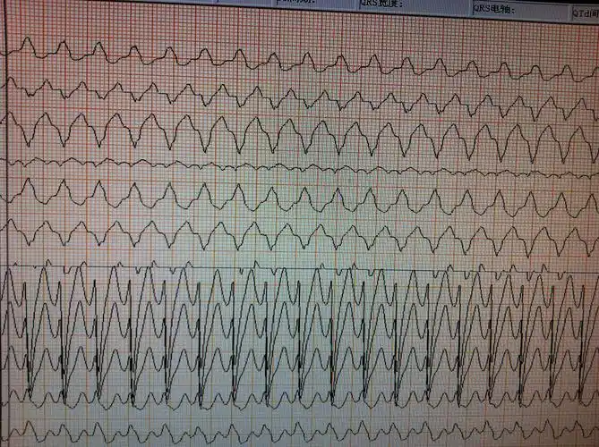 大家来分析分析 - 心电图脑电图专业讨论版 - 爱爱医医学论坛