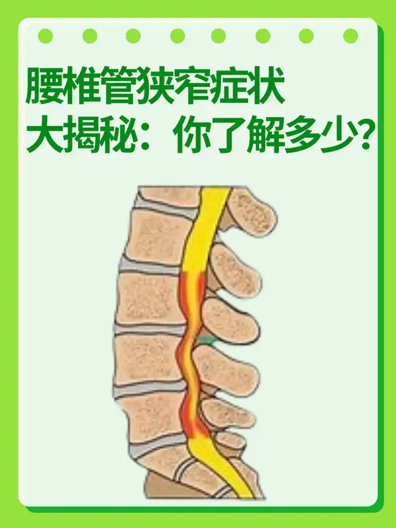 97腰椎管狭窄症状大揭秘:你了解多少?