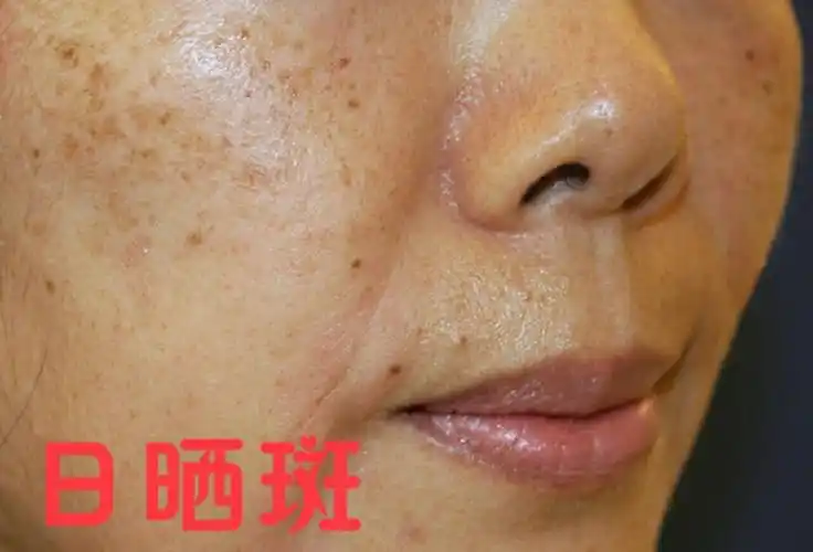 日晒斑形成原因