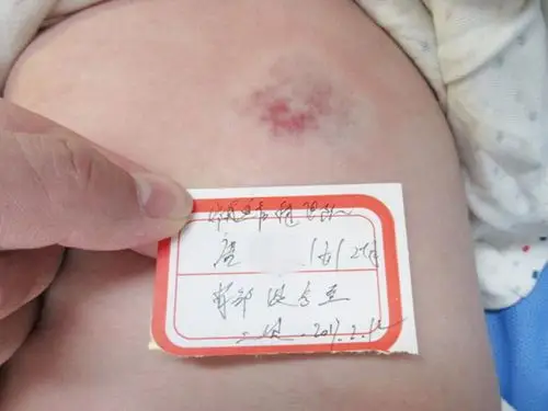 经检查确诊为混合型血管瘤,家长选择微创方法进行治疗,一个疗程结束后