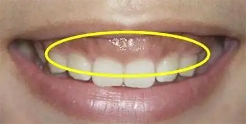 有牙龈炎的人养成这3个习惯牙龈炎很快就好不再犯