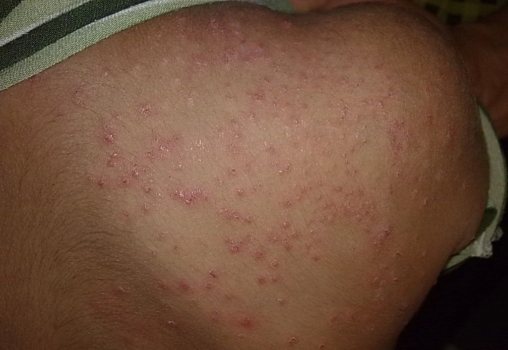 皮肤蝇蛆病会出现低热,头痛,恶心等全身症状,属于皮肤疾病