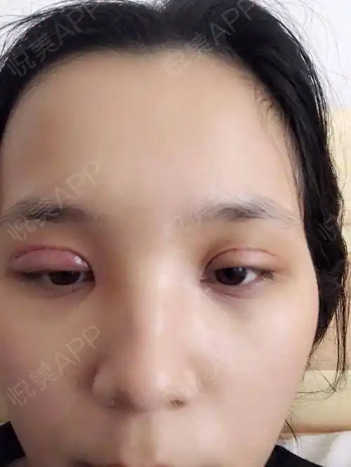 双眼皮术后7天啦~~去医院拆线了,拆线我觉得还是挺疼的,到拆完回家