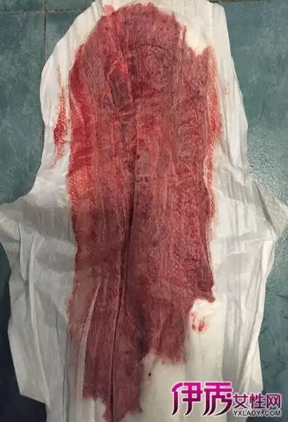 子宫内膜周期性的脱落而导致的阴道出血,月经周期是生理上的循环周期