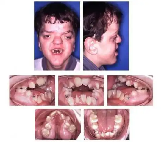 儿童七种常见颅面畸形你认识哪一种