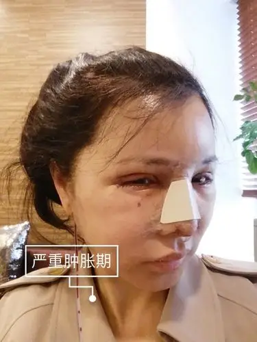【术后第3天】因为做了面部拉皮这几天需要戴上绷带的_圈子-新氧美容