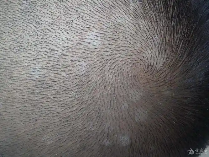 12岁男孩,头皮出现豆大的白色斑片,糠屑,是头皮糠疹?