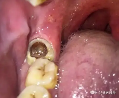 最里面那颗牙齿是蛀牙空了三分之一疼了有半年到底怎么办