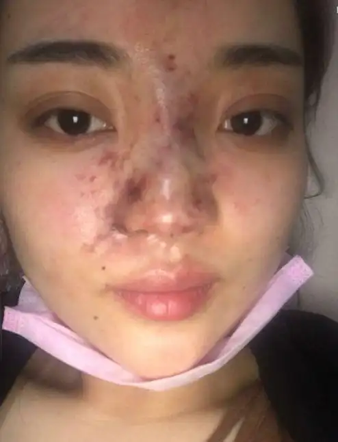 玻尿酸注射隆鼻为什么会导致血管栓塞