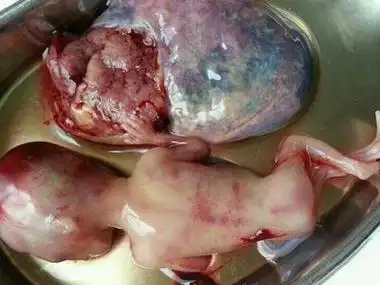 胎儿被拿掉后这残酷的瞬间,希望能明白生命的可贵.