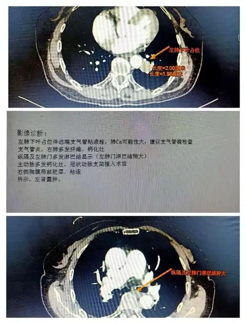 小细胞肺癌(广泛期),化疗