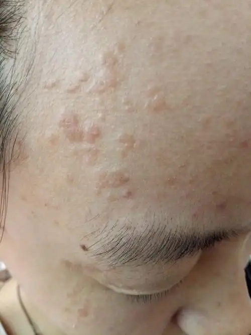 是什么原因导致扁平疣出现