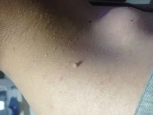 皮肤病:肩膀上方,颈下长了一个类似米粒似的东西,请懂这方面的专家给