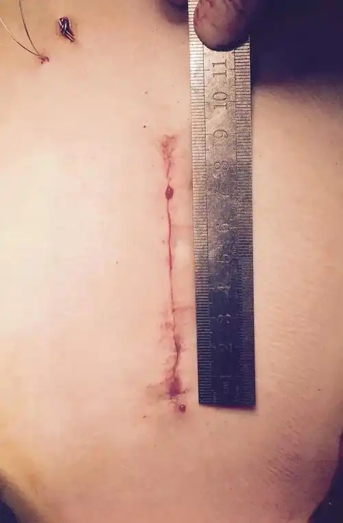 小切口复杂心脏瓣膜手术 - 好大夫在线