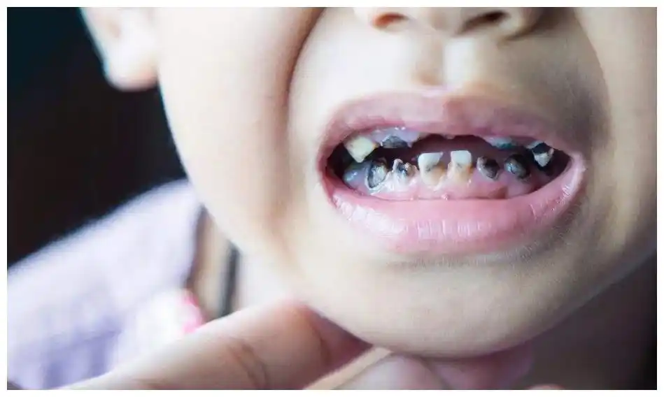 小孩子牙齿变黑,大部分都是这样造成的,年轻爸妈注意了