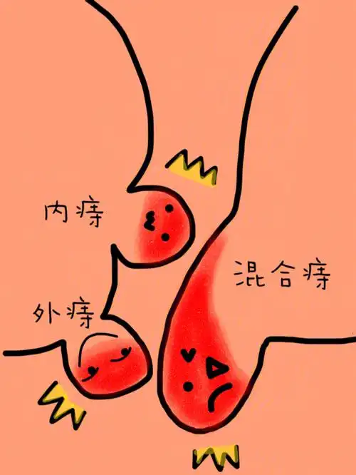 外痔肛裂真的快崩溃了