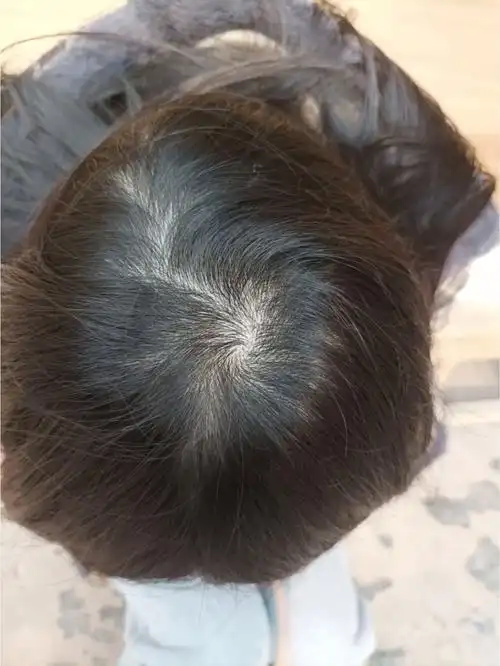 脱发严重怎么办