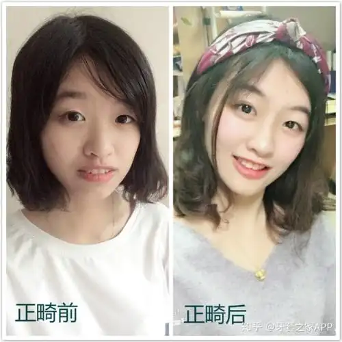 戴牙套带来的容貌上的大改观是一种怎样的体验