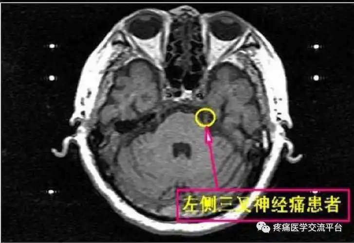 三叉神经解剖及mr表现