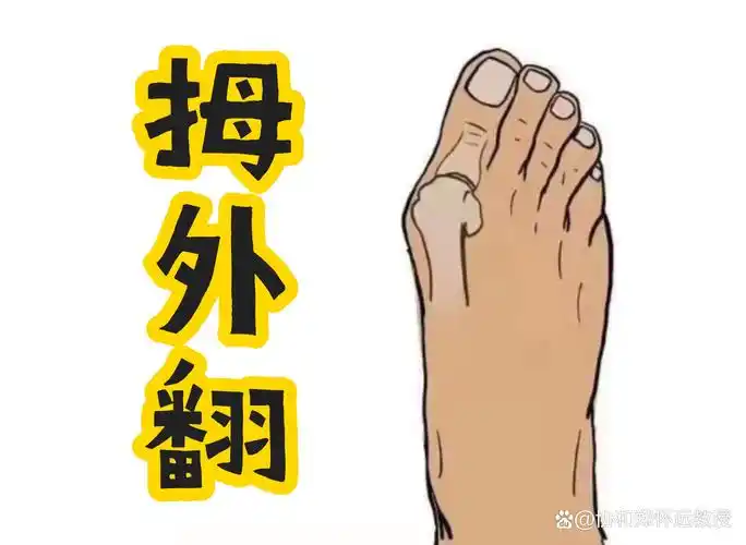 是不是你?大脚趾歪,穿鞋总磨脚还爱起茧?