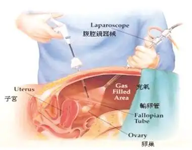 【图解疾病】宫外孕(异位妊娠)