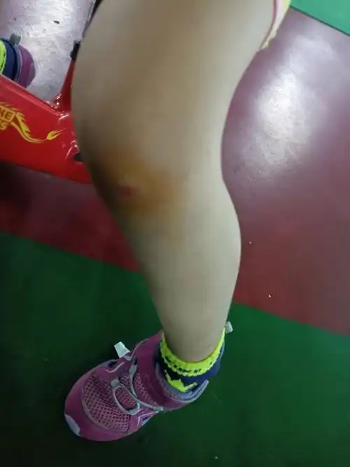 忙忘了给骑你带护具,摔跤把膝盖破皮了,啊啊大哭,第二天奶奶都受伤还