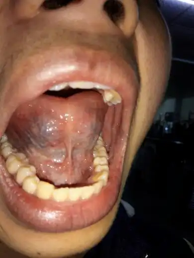 看下舌底有什么问题?