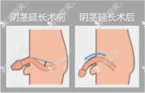四川增大增长手术多少钱增粗哪家医院好个人经历分享