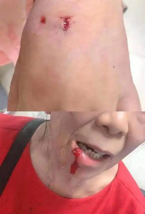 21人遭袭最小的才3岁跳起来对着胳膊就咬近期高发记住这几点能保命