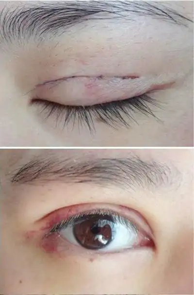 割双眼皮正常伤口图片